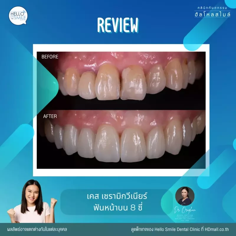 รีวิว ทำวีเนียร์ เซรามิก ที่ Hello Smile Dental Clinic