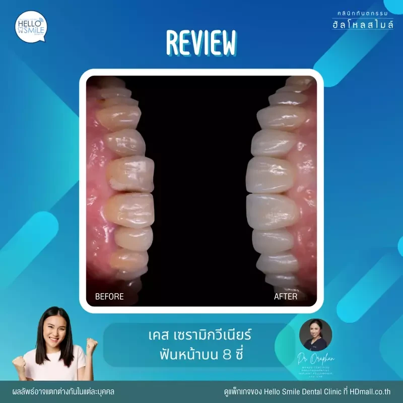 รีวิว ทำวีเนียร์ เซรามิก ที่ Hello Smile Dental Clinic