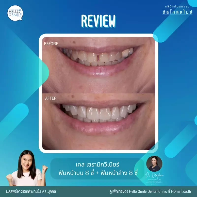 รีวิว ทำวีเนียร์ เซรามิก ที่ Hello Smile Dental Clinic