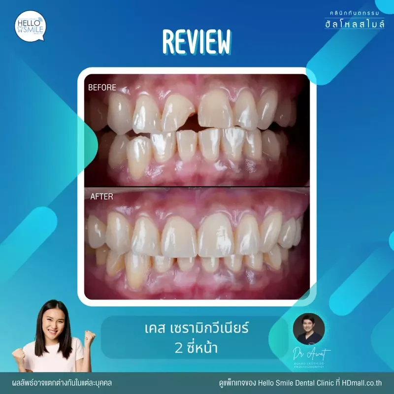 รีวิว ทำวีเนียร์ เซรามิก ที่ Hello Smile Dental Clinic