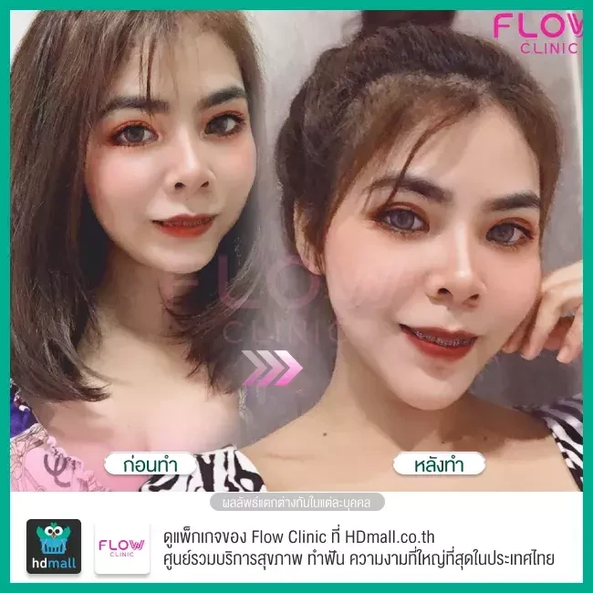 รีวิว เสริมคาง ที่ Flow Clinic