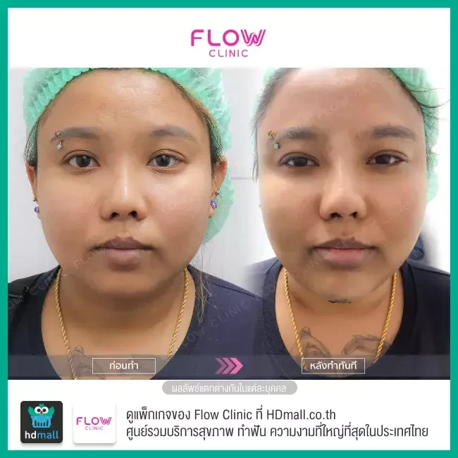 รีวิว เสริมคาง ที่ Flow Clinic