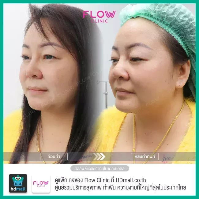 รีวิว เสริมคาง ที่ Flow Clinic