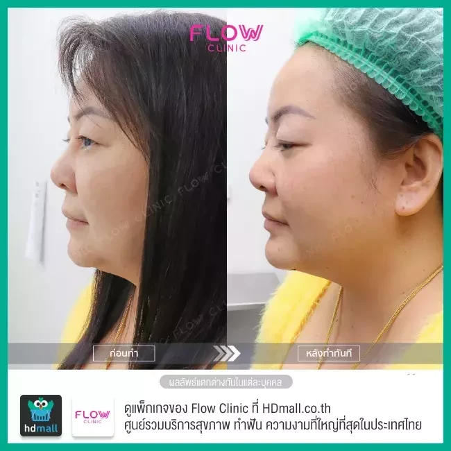 รีวิว เสริมคาง ที่ Flow Clinic