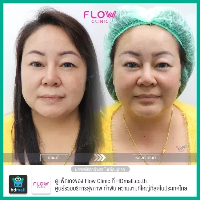 รีวิว เสริมคาง ที่ Flow Clinic