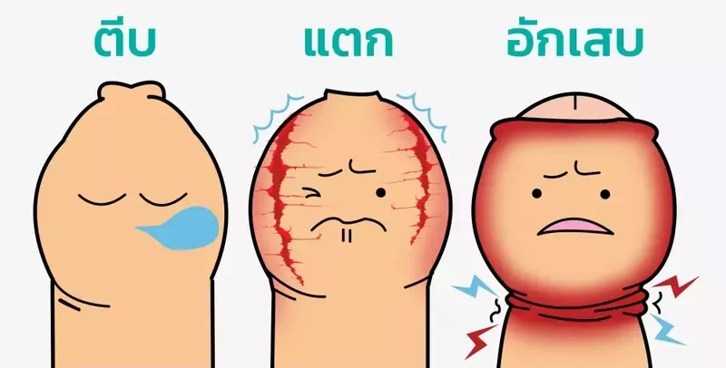 รีวิว ขริบหนังหุ้มปลายอวัยวะเพศชาย ที่ Gentle Clinic 3 content review before after circumcision at gentle clinic 1