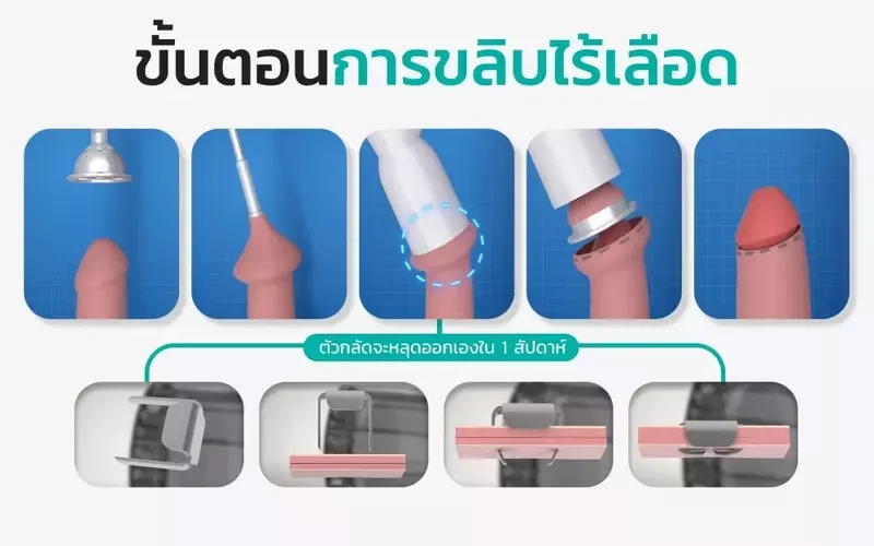 ขั้นตอนการขริบหนังหุ้มปลายอวัยวะเพศชาย ที่ Gentle Clinic