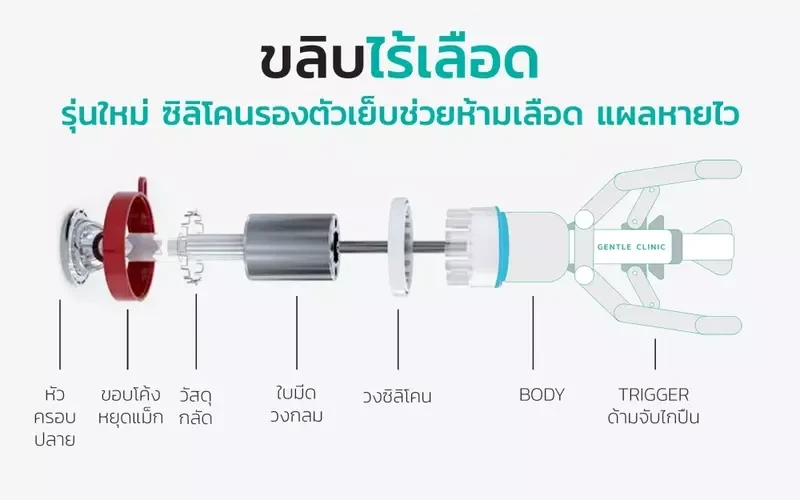 อุปกรณ์ขริบไร้เลือด ที่ Gentle Clinic