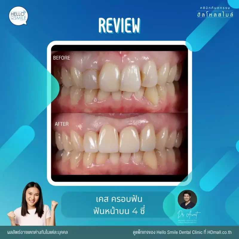 รีวิว ทำครอบฟัน ที่ Hello Smile Dental Clinic