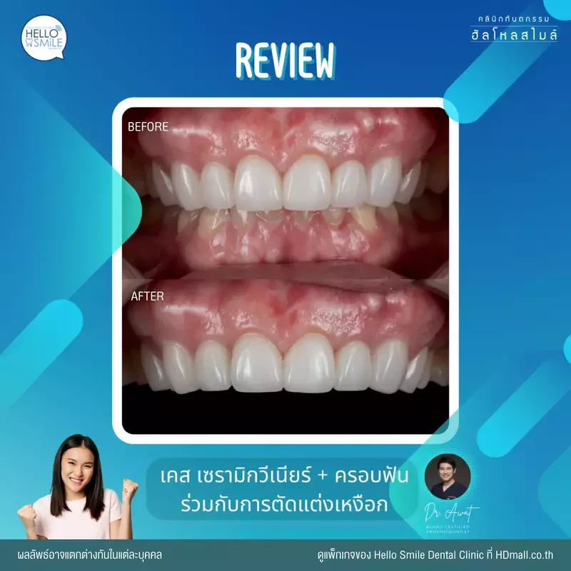 รีวิว ทำครอบฟัน ที่ Hello Smile Dental Clinic