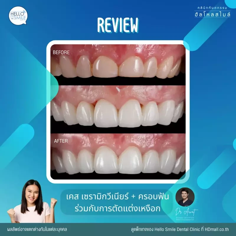 รีวิว ทำครอบฟัน ที่ Hello Smile Dental Clinic