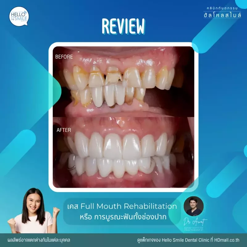 รีวิว ทำครอบฟัน ที่ Hello Smile Dental Clinic