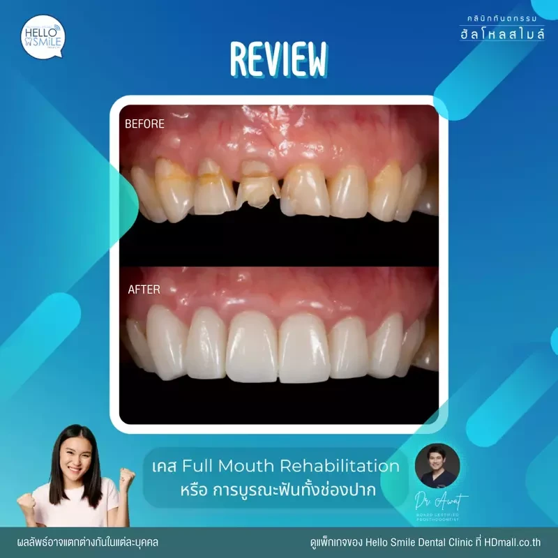 รีวิว ทำครอบฟัน ที่ Hello Smile Dental Clinic