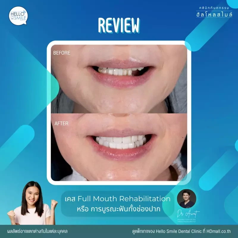 รีวิว ทำครอบฟัน ที่ Hello Smile Dental Clinic