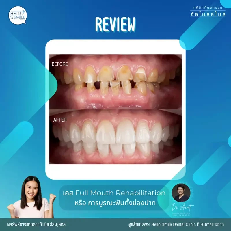 รีวิว ทำครอบฟัน ที่ Hello Smile Dental Clinic