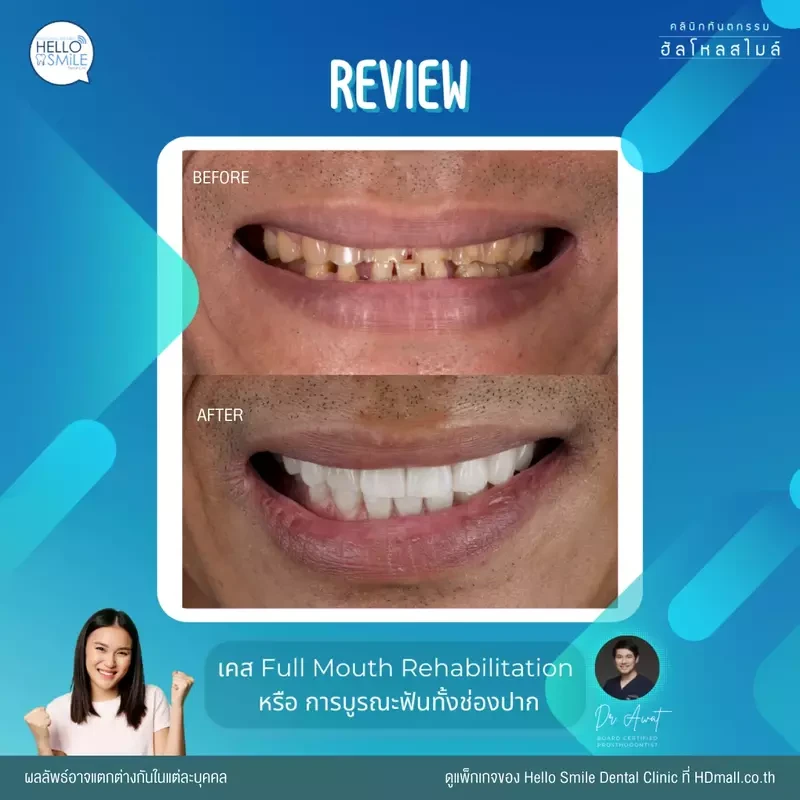 รีวิว ทำครอบฟัน ที่ Hello Smile Dental Clinic