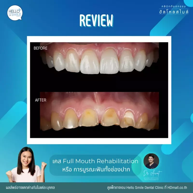 รีวิว ทำครอบฟัน ที่ Hello Smile Dental Clinic