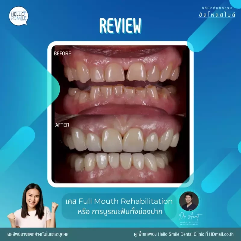 รีวิว ทำครอบฟัน ที่ Hello Smile Dental Clinic