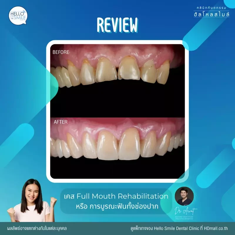 รีวิว ทำครอบฟัน ที่ Hello Smile Dental Clinic