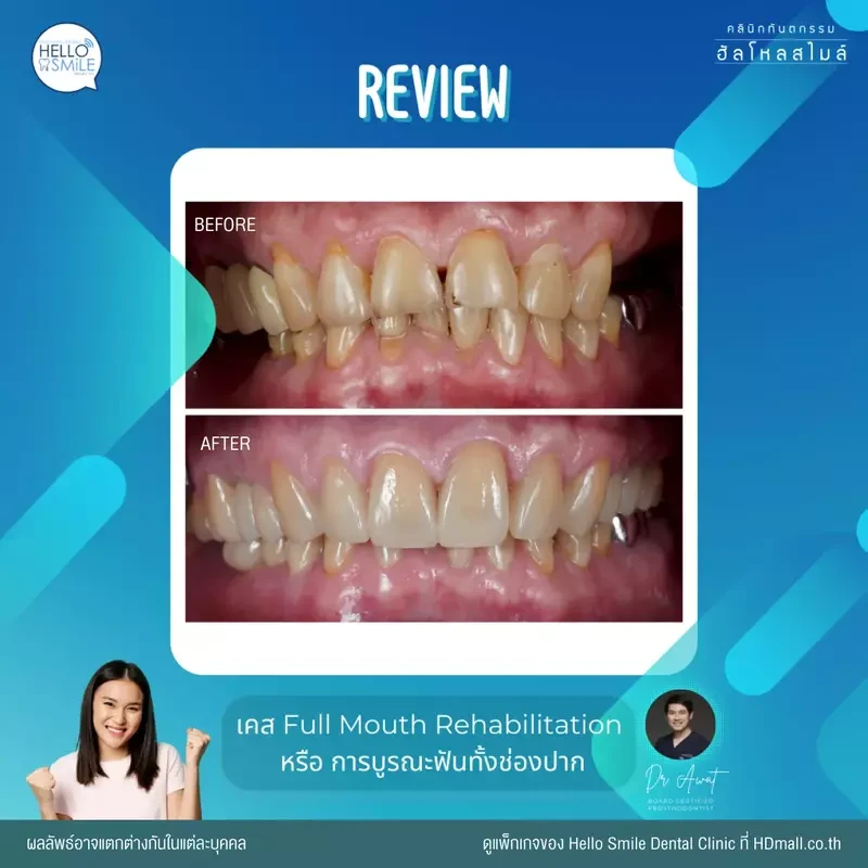 รีวิว ทำครอบฟัน ที่ Hello Smile Dental Clinic
