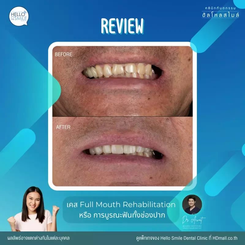 รีวิว ทำครอบฟัน ที่ Hello Smile Dental Clinic