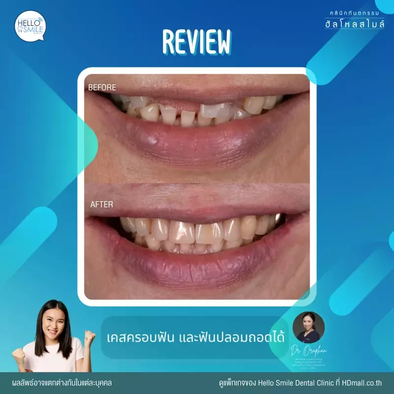 รีวิว ทำครอบฟัน ที่ Hello Smile Dental Clinic