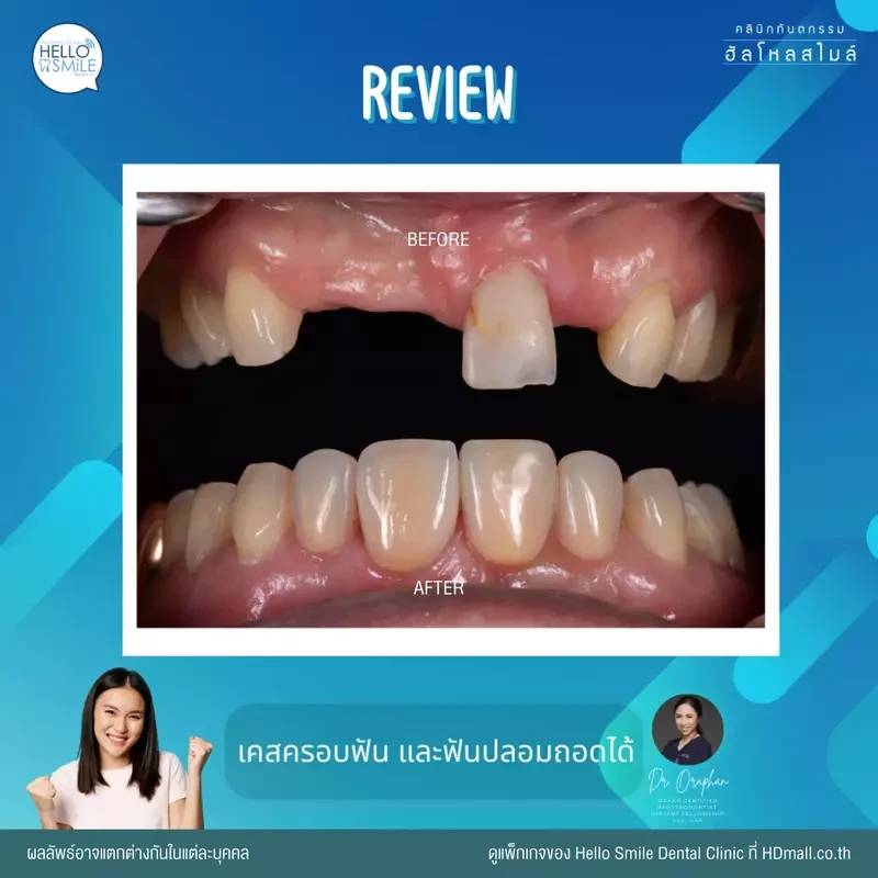 รีวิว ทำครอบฟัน ที่ Hello Smile Dental Clinic