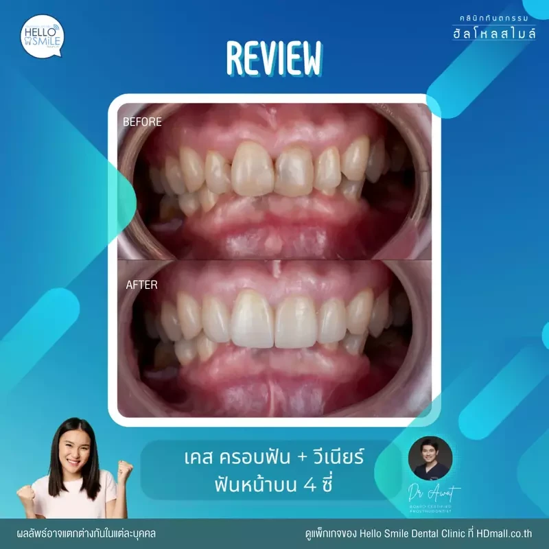 รีวิว ทำครอบฟัน ที่ Hello Smile Dental Clinic