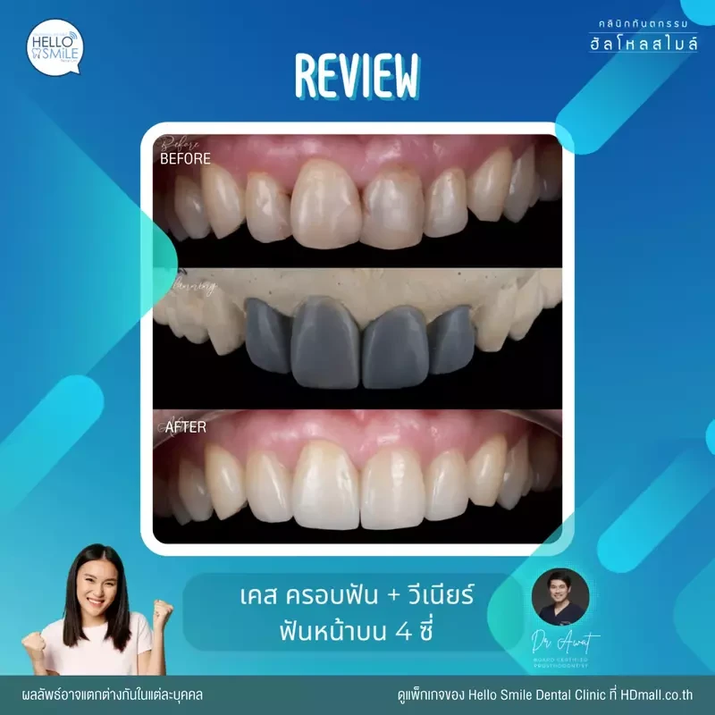 รีวิว ทำครอบฟัน ที่ Hello Smile Dental Clinic