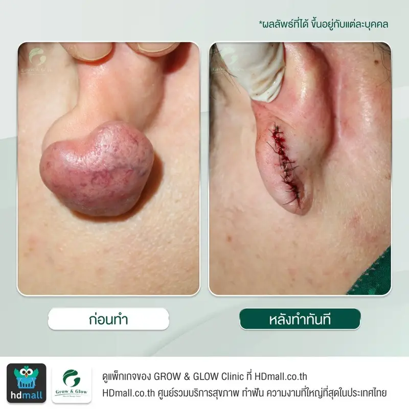 รวมรูปรีวิว ตัดคีลอยด์ ที่ GROW & GLOW Clinic