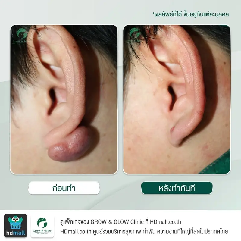 รวมรูปรีวิว ตัดคีลอยด์ ที่ GROW & GLOW Clinic