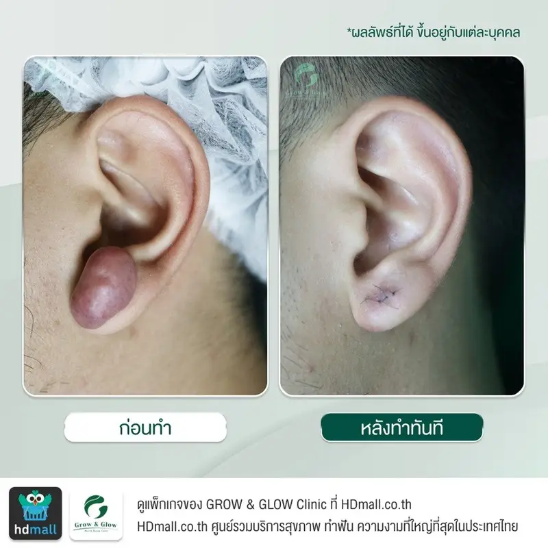 รวมรูปรีวิว ตัดคีลอยด์ ที่ GROW & GLOW Clinic