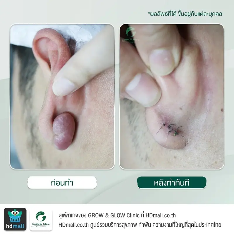 รวมรูปรีวิว ตัดคีลอยด์ ที่ GROW & GLOW Clinic