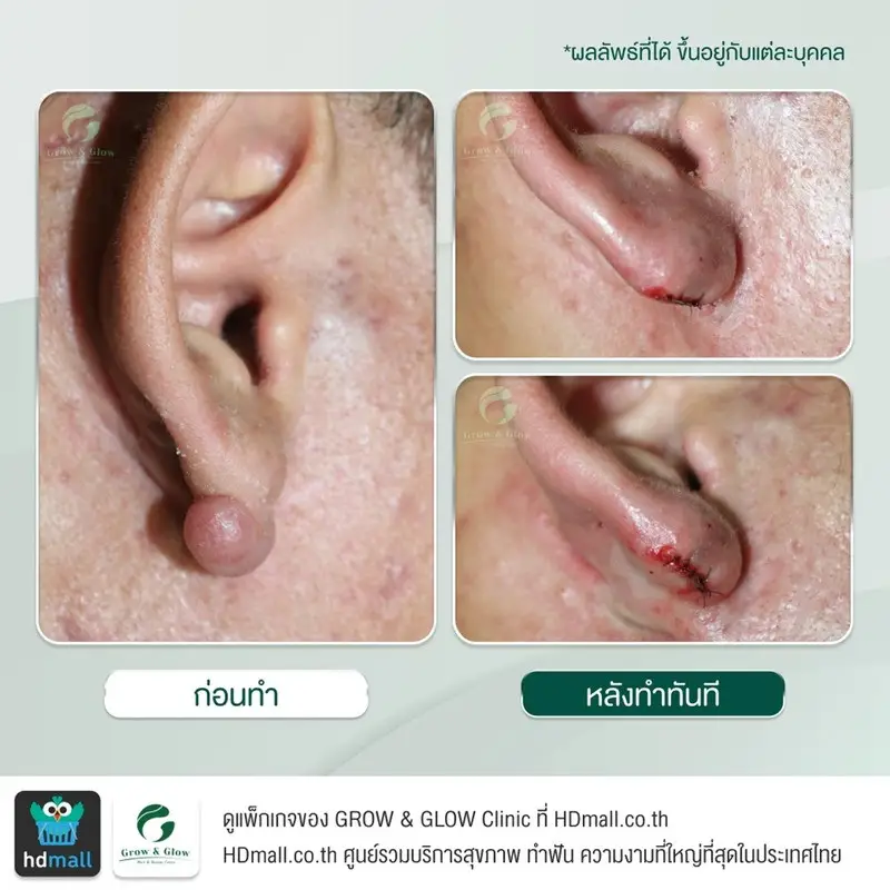 รวมรูปรีวิว ตัดคีลอยด์ ที่ GROW & GLOW Clinic