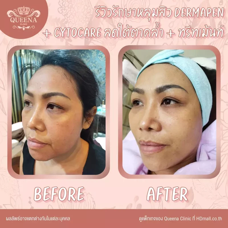 รีวิว ฉีด Cytocare ที่ Queena Clinic
