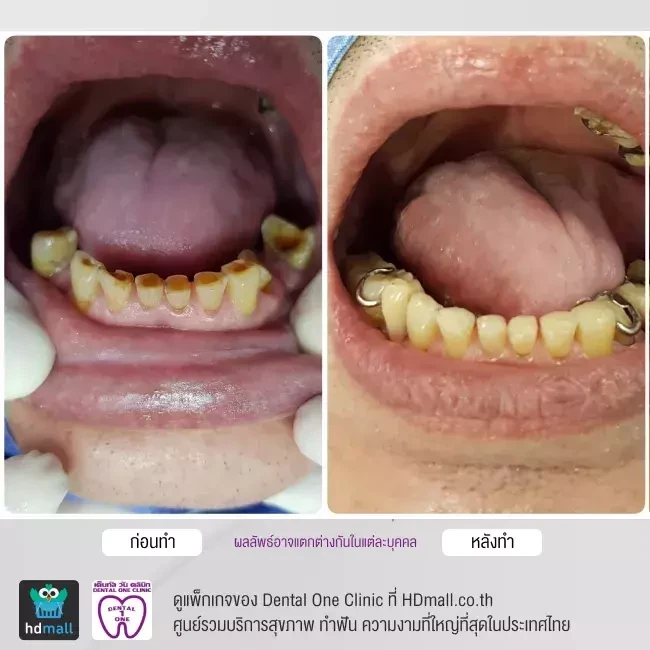รีวิว อุดฟัน ที่ Dental One Clinic