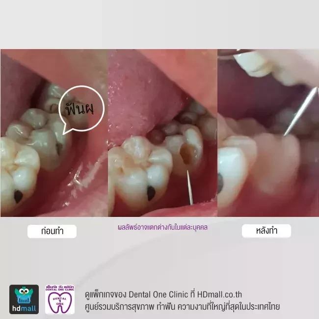 รีวิว อุดฟัน ที่ Dental One Clinic