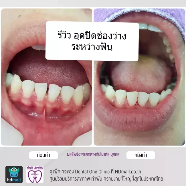 รีวิว อุดฟัน ที่ Dental One Clinic