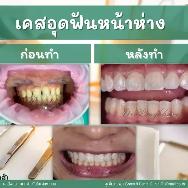 รีวิว อุดฟันห่าง ที่ Green 9 Dental Clinic