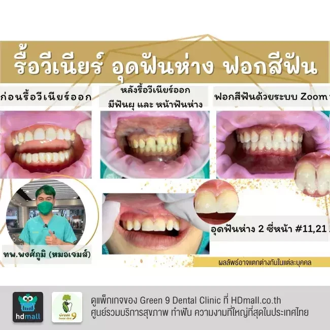 รีวิว อุดฟันห่าง ที่ Green 9 Dental Clinic