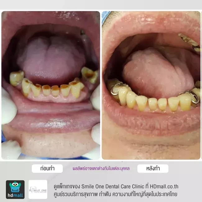 รีวิว อุดฟัน ที่ Smile One Dental Care Clinic