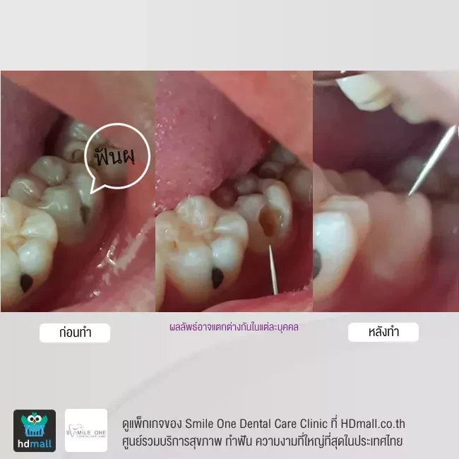 รีวิว อุดฟัน ที่ Smile One Dental Care Clinic