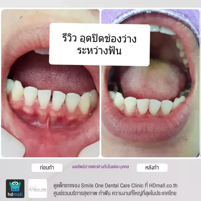 รีวิว อุดฟัน ที่ Smile One Dental Care Clinic
