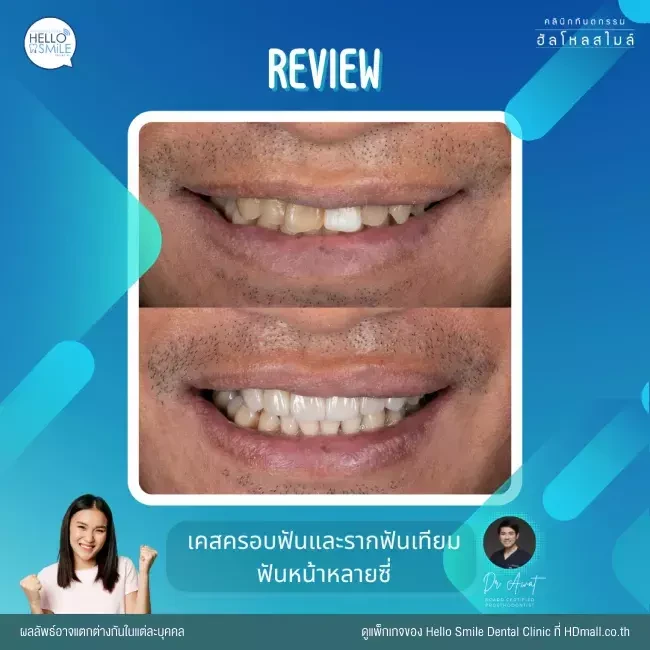 รีวิว ทำรากฟันเทียม ที่ Hello Smile Dental Clinic