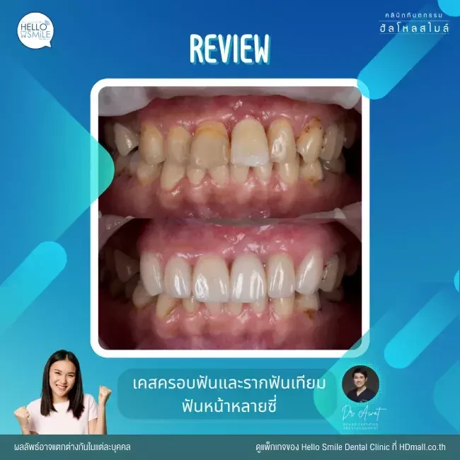 รีวิว ทำรากฟันเทียม ที่ Hello Smile Dental Clinic