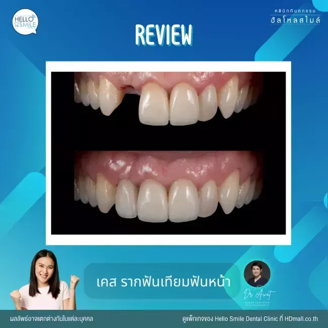 รีวิว ทำรากฟันเทียม ที่ Hello Smile Dental Clinic