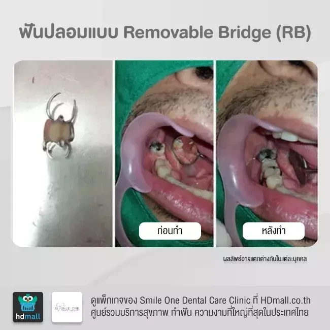 รีวิว ทำฟันปลอม ที่ Smile One Dental Care Clinic