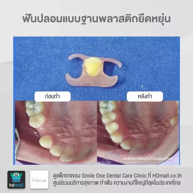 รีวิว ทำฟันปลอม ที่ Smile One Dental Care Clinic