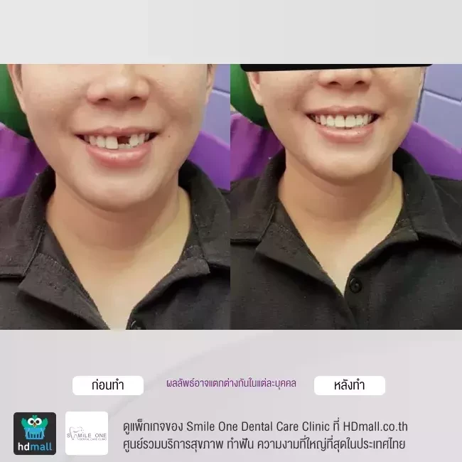 รีวิว ทำฟันปลอม ที่ Smile One Dental Care Clinic
