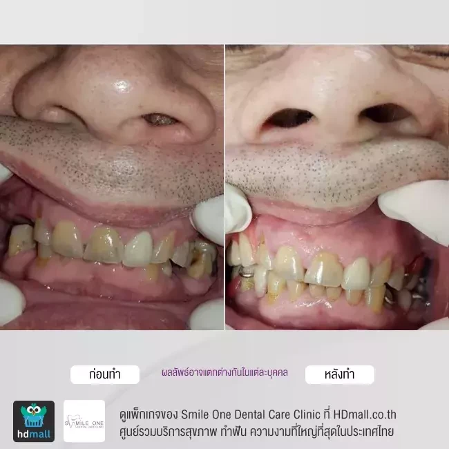 รีวิว ทำฟันปลอม ที่ Smile One Dental Care Clinic